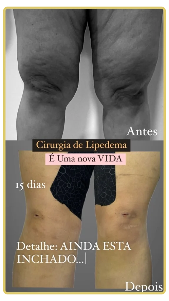 LIPO HD LIPEDEMA – drroggercirurgiaplastica.com.br